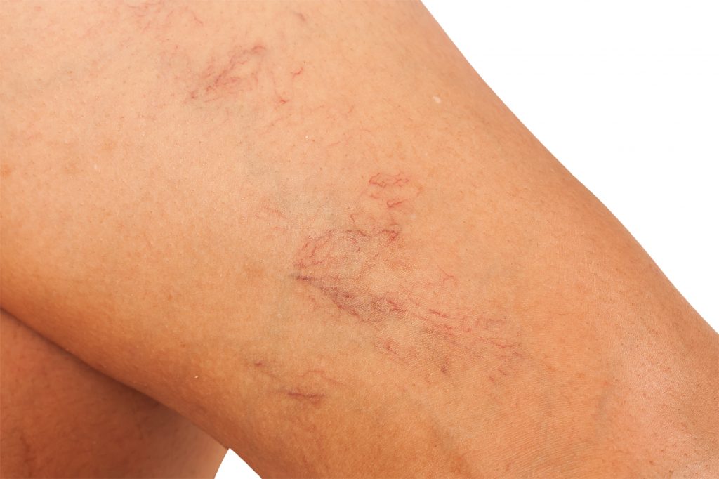 Close-up of woman's leg prior to receiving vein therapy