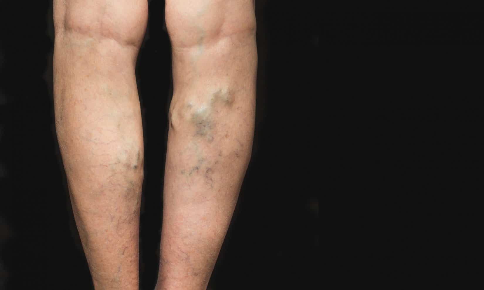 Varicose veins on a female legs