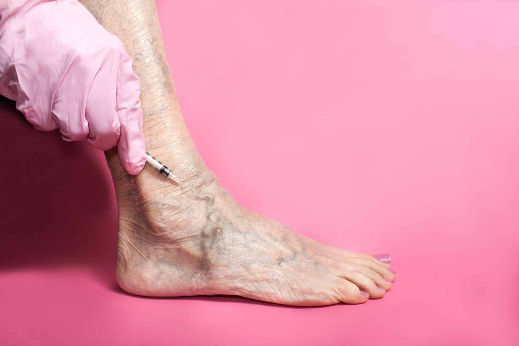 Treatment of varicose veins via syringe