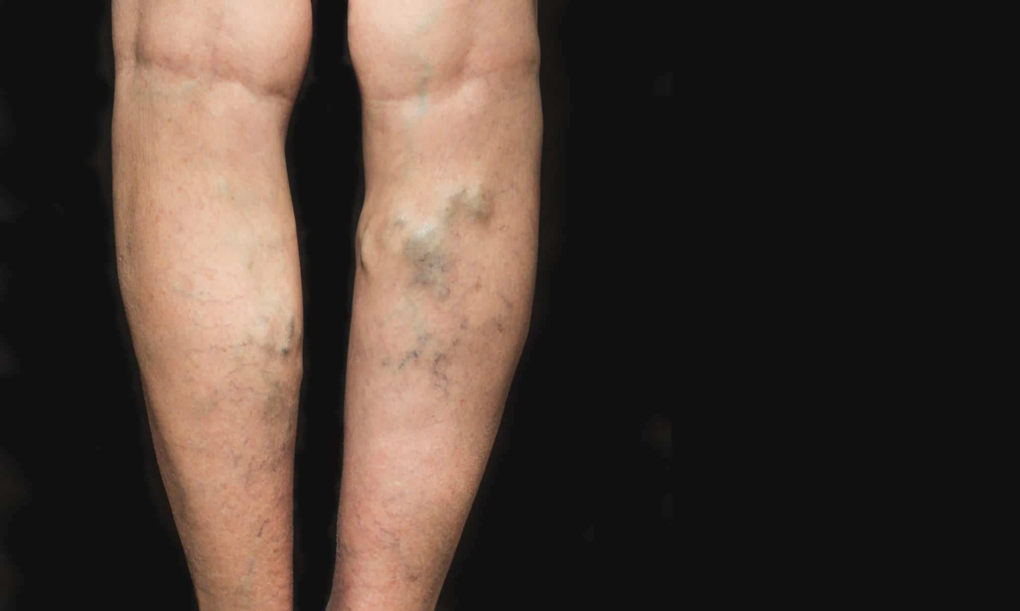 How to Get Rid of Varicose Veins