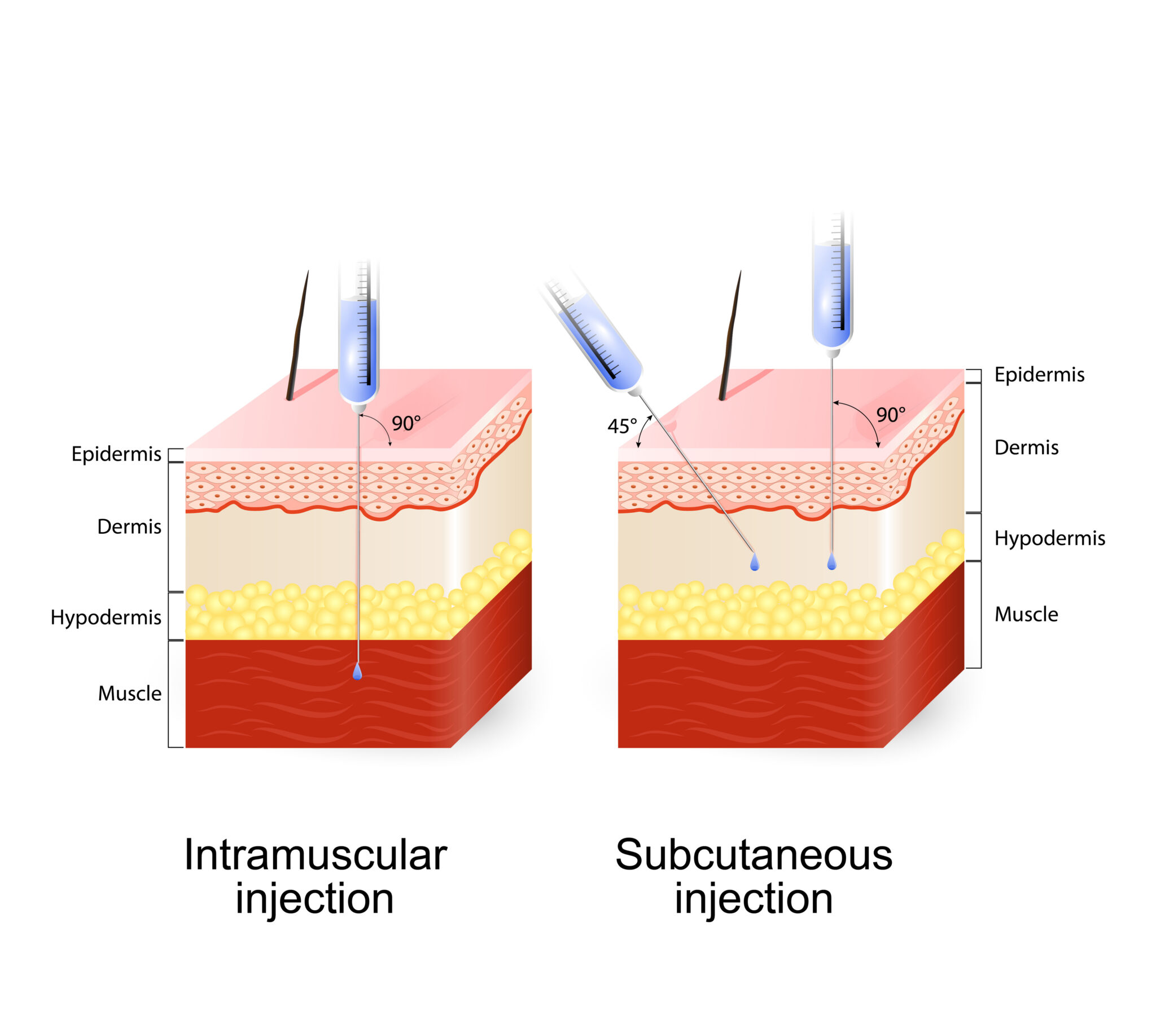 Illustration comparing intramuscular and subcutaneous injection techniques with needle angles and tissue layers.