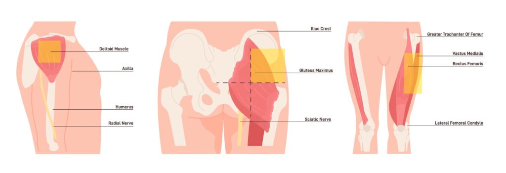 Illustration of intramuscular injection sites with labeled muscles and nerves: deltoid (upper arm), gluteus maximus (buttock), and vastus lateralis/rectus femoris (thigh), highlighting safe injection zones.